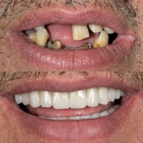 before-after photo dental-implant
