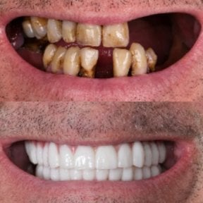 before-after photo dental-implant