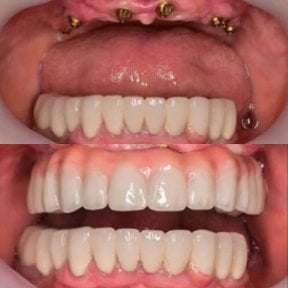 before-after photo dental-implant