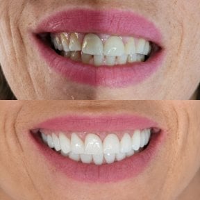 before-after photo installation-of-a-veneer