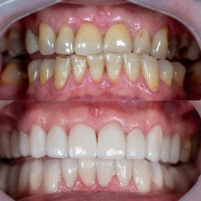 before-after photo installation-of-a-veneer