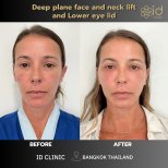 Результаты до и после фейслифтинга и подтяжки шеи в ID Clinic Bangkok, омоложение лица