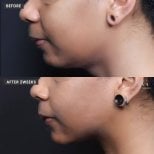 Vorher-nachher-Ergebnis Kinn-Liposuktion bei VG Plastic Surgery – verbesserte Kinnlinie