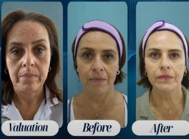 before-after photo botox-injections