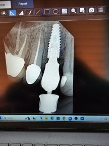 before-after photo installation-of-a-dental-implant-with-crown