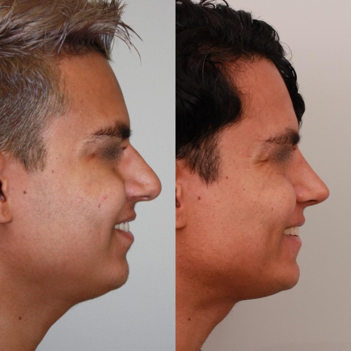 نتائج قبل وبعد عملية تجميل الأنف المغلقة، تحسين شكل الأنف وتناسق الوجه