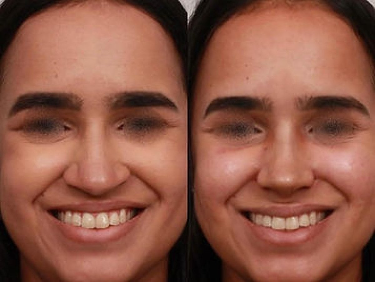 before-after photo