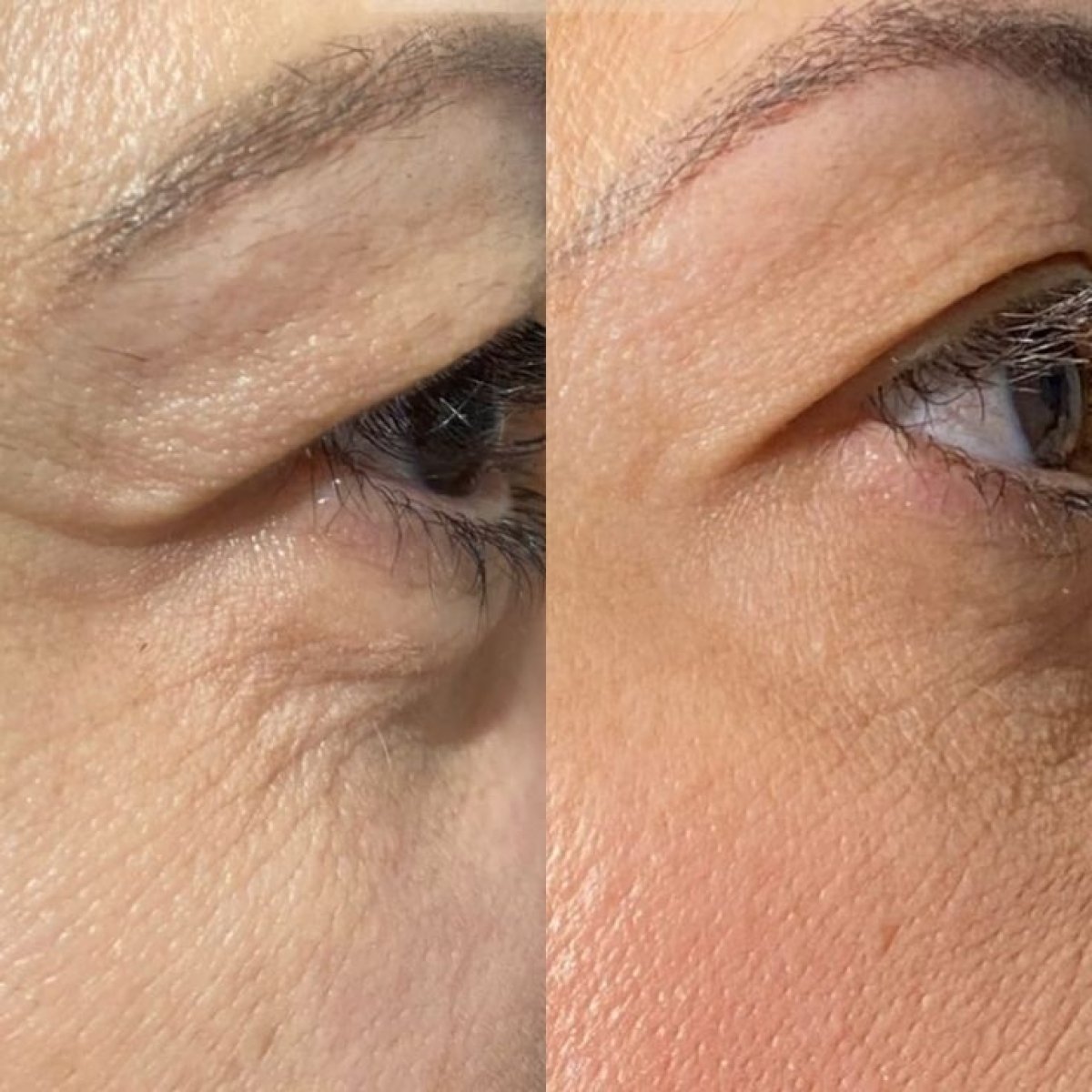 Resultados de blefaroplastia antes y después – corrección de párpados y piel más lisa