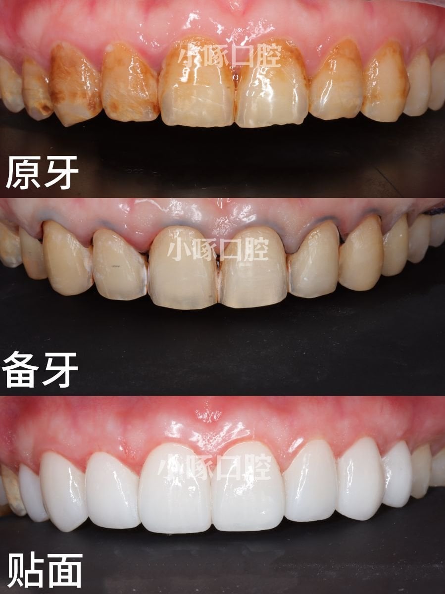 قبل وبعد قشور الأسنان في VBright Dental – نتائج تحول الابتسامة