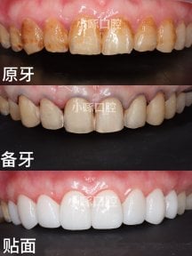 before-after photo installation-of-a-veneer