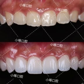 before-after photo installation-of-a-veneer