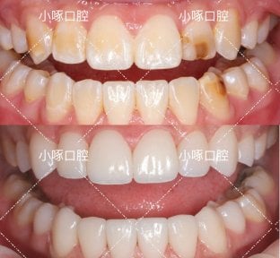 before-after photo installation-of-a-veneer