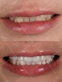 before-after photo installation-of-a-veneer