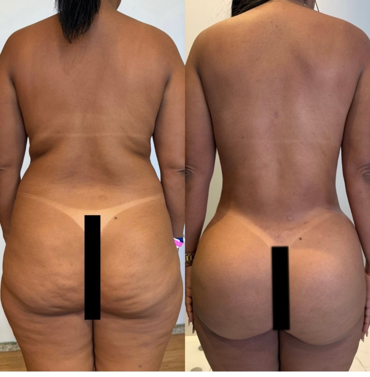 نتائج قبل وبعد عملية Brazilian Butt Lift – تحسين شكل الأرداف وتحديد الخصر