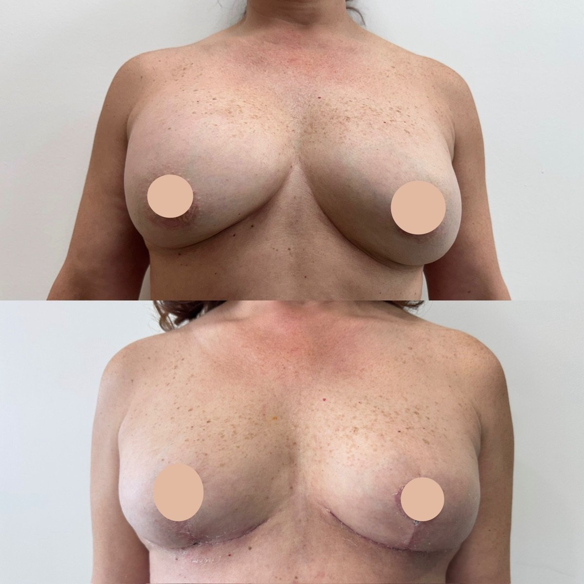 Resultados antes y después de mastopexia en Dr. Yazmin Sánchez Delgado, mejor contorno