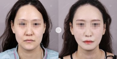 Resultado de liposucción de papada antes y después en Lienjang Plastic Surgery & Aesthetic Clinic