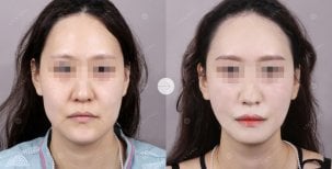 Resultado de liposucción de papada antes y después en Lienjang Plastic Surgery & Aesthetic Clinic
