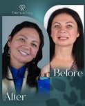 До та після встановлення вінірів у клініці Dentaray – природне перетворення посмішки