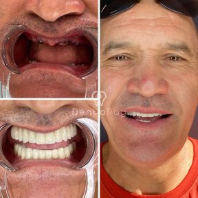 نتائج قبل وبعد زراعة الغرسات الوجنية في Dentaray Clinic – استعادة الابتسامة الكاملة