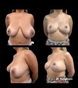 Результаты до и после подтяжки груди в Dr. Michel Salameh - Plastic And Aesthetic Surgery