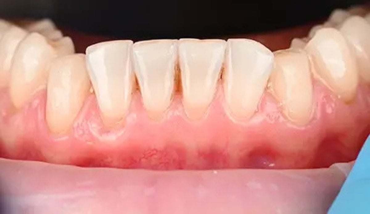 Resultado de carillas dentales: mejora en la apariencia de los dientes inferiores