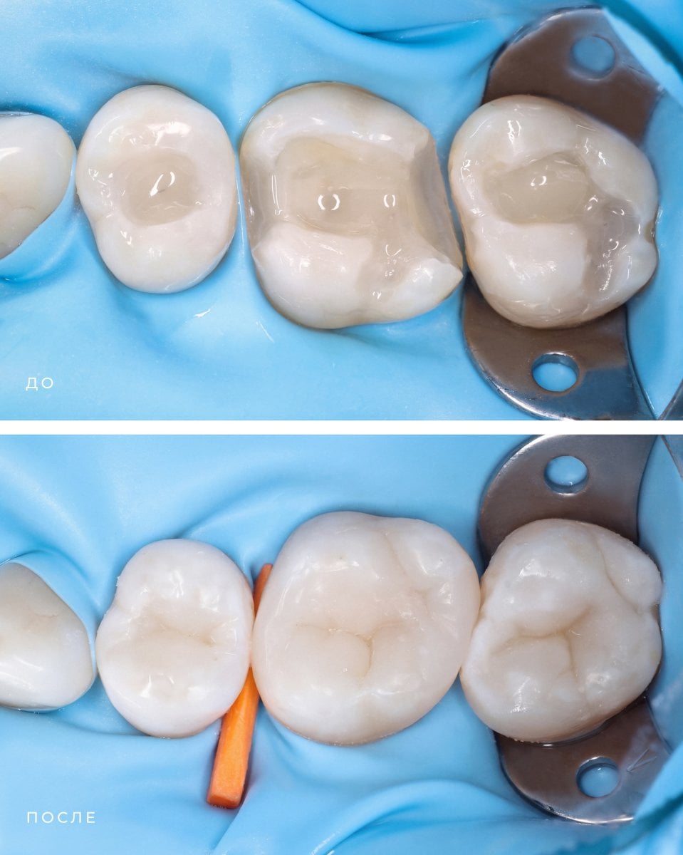 before-after photo