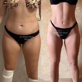 before-after photo liposakciya