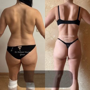 before-after photo liposakciya