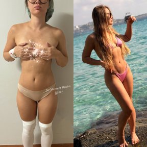 before-after photo vaser-liposuction