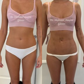 before-after photo vaser-liposuction