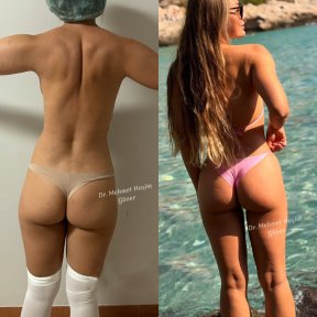 before-after photo vaser-liposuction