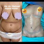 Before and after tummy tuck results at Op. Dr. Mehmet Haşim Güner, visible abdominal contour