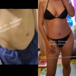 Before and after tummy tuck results at Op. Dr. Mehmet Haşim Güner, visible flat abdomen