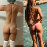 Resultados antes y después de Brazilian Butt Lift en Op. Dr. Mehmet Haşim Güner, curvas mejoradas