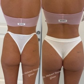 Resultados antes y después de Brazilian Butt Lift en Op. Dr. Mehmet Haşim Güner, curvas mejoradas