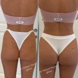 Resultados antes y después de Brazilian Butt Lift en Op. Dr. Mehmet Haşim Güner, curvas mejoradas