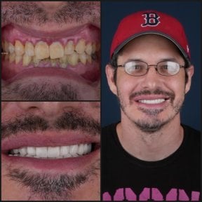 before-after photo dental-crown-installation