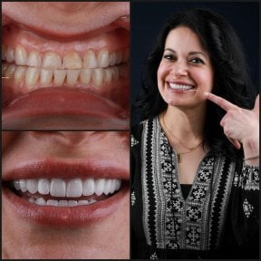 before-after photo dental-crown-installation