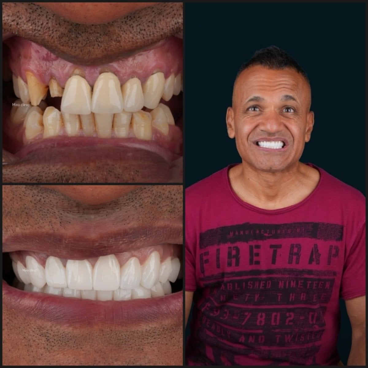 before-after photo