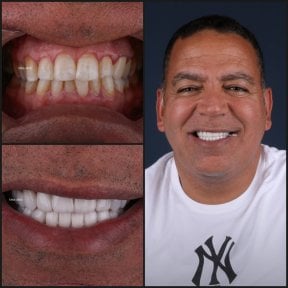 before-after photo dental-crown-installation
