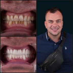 before-after photo dental-crown-installation