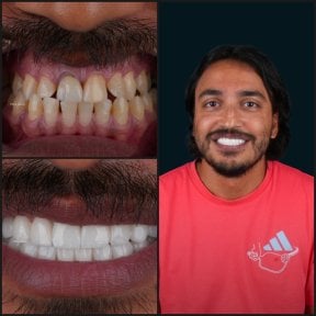 before-after photo dental-crown-installation