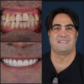 before-after photo dental-crown-installation