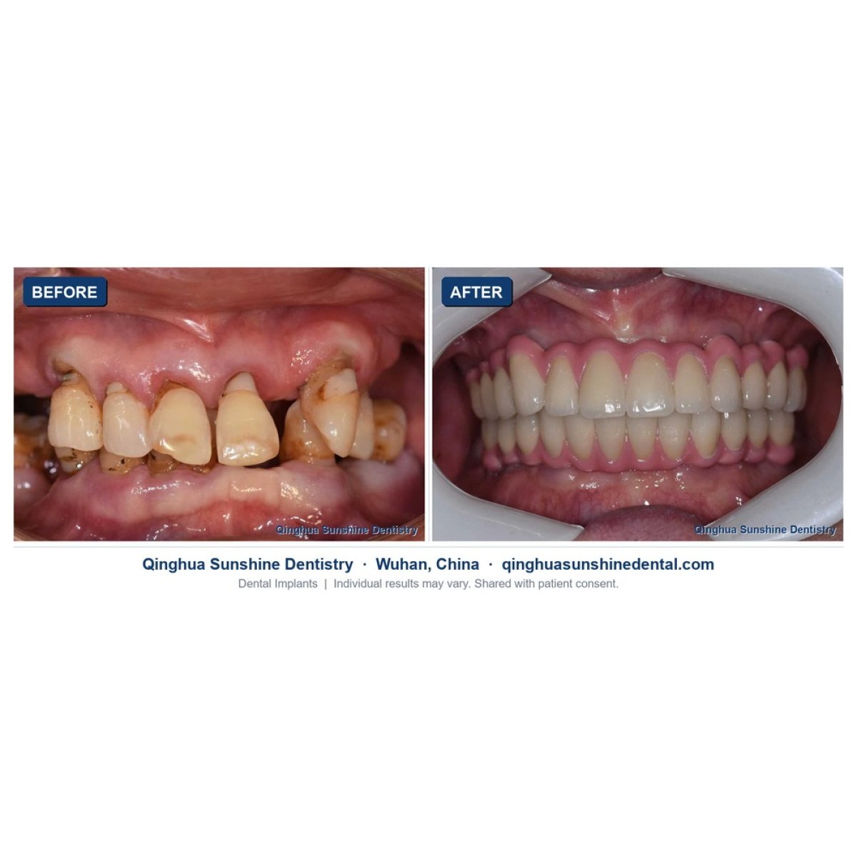 before-after photo