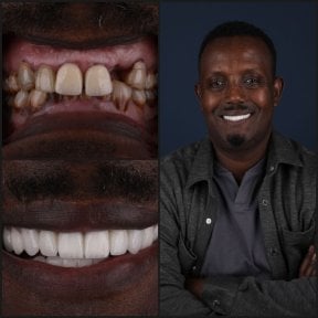 before-after photo dental-crown-installation