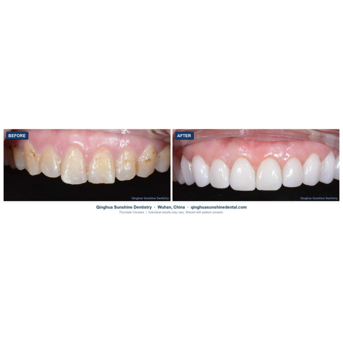 before-after photo
