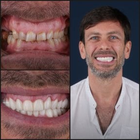 before-after photo dental-crown-installation