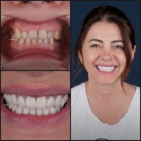 before-after photo dental-crown-installation