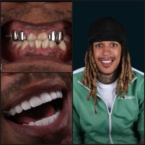 before-after photo dental-crown-installation