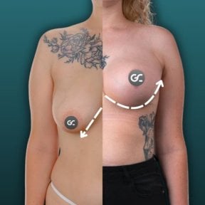 before-after photo breast-augmentation